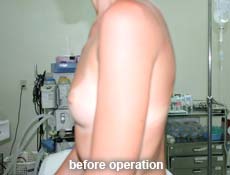 plastic-surgery-breast-augmentation 